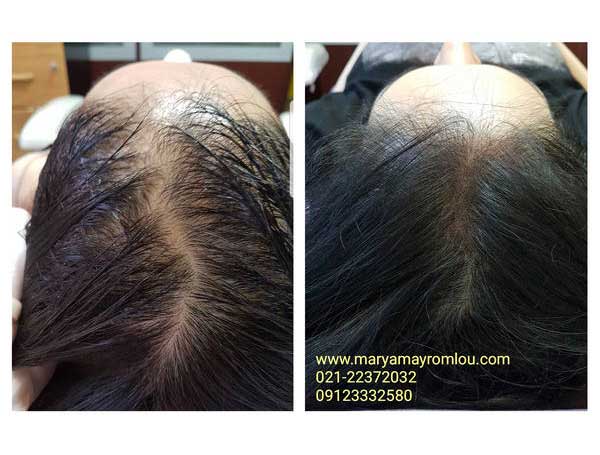 scalp for women