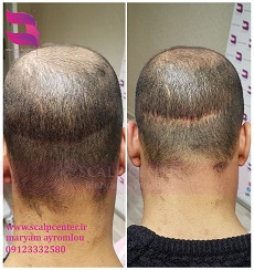 از بین بردن جای بخیه با اسکالپ