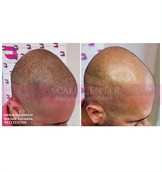 اسکالپ سرهای طاس (اسپرت)