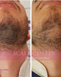 اسکالپ ریش و سبیل