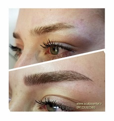 میکروپیگمنتیشن صورت