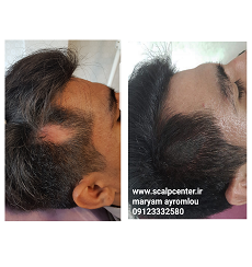 اسکالپ سه بعدی