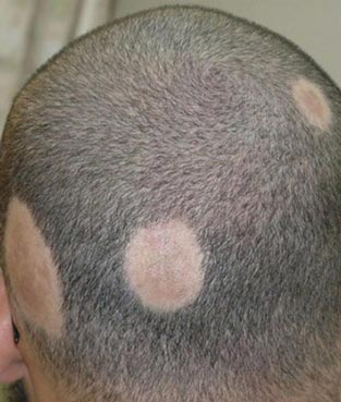 اسکالپ آلوپسی