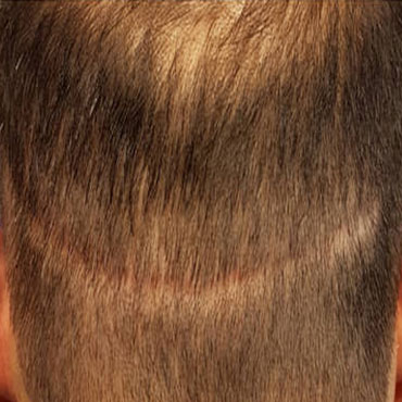 ترمیم جای بخیه کاشت مو با اسکالپ