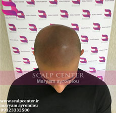 ویدئو اسکالپ سرهای طاس (اسپرت )