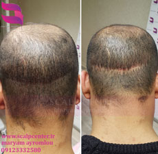 ویدئو از بین بردن محل برداشت کاشت مو