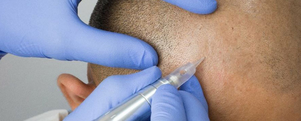 عوارض میکروپگمنتیشن