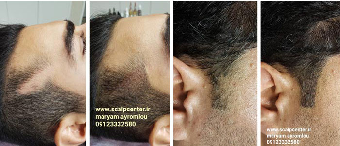 اسکالپ سه بعدی